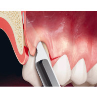 INNESTI DI TESSUTO CONNETTIVO E MATRICI SOSTITUTIVE + TECNICHE DI AVANZAMENTO PASSIVO DEI LEMBI