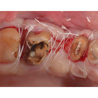 L'ALLUNGAMENTO DELLA CORONA CLINICA. Tecniche chirurgiche convenzionali e nuovi approcci per l’odontoiatria restaurativa