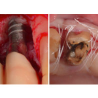 IL TRATTAMENTO DELLE PERI-IMPLANTITI + TECNICHE DI AVANZAMENTO PASSIVO DEI LEMBI
