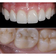 INTARSI IN COMPOSITO NEI SETTORI POSTERIORI + FACCETTE IN CERAMICA NEI SETTORI ANTERIORI