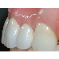 TECNICHE CHIRURGICHE E TECNICHE PROTESICHE PER LA STABILITA’ DEL MARGINE GENGIVALE E DELLE PAPILLE SU DENTI NATURALI