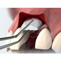 INNESTI DI TESSUTO CONNETTIVO E MATRICI SOSTITUTIVE. Tecniche chirurgiche per denti naturali e impianti
