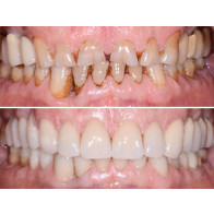 FACCETTE DIRETTE ED INDIRETTE: APPROCCIO DIGITALE E MINI-INVASIVO