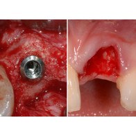 RIGENERAZIONE OSSEA CON TECNICHE SEMPLIFICATE + TECNICHE E STRATEGIE CHIRURGICHE PER GLI IMPIANTI NELLE ZONE ESTETICHE: