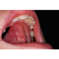 CORRELAZIONE TRA DEGLUTIZIONE ATIPICA E RESPIRAZIONE ORALE: soluzioni con terapie elastodontiche