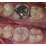 INTARSI IN COMPOSITO NEI SETTORI POSTERIORI