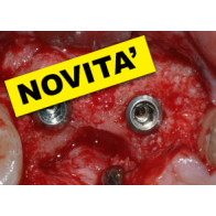 RIGENERAZIONE OSSEA CON TECNICHE SEMPLIFICATE: differenti approcci per differenti situazioni cliniche in implantologia