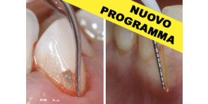MALATTIE PARADONTALI E PERI-IMPLANTITI + TERAPIA PARODONTALE LASER ASSISTITA