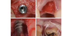 FULL IMMERSION SULLA GESTIONE DEI TESSUTI DURI E MOLLI IN IMPLANTOLOGIA
