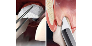 INNESTI DI TESSUTO CONNETTIVO E MATRICI SOSTITUTIVE + L'ALLUNGAMENTO DELLA CORONA CLINICA 