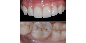 INTARSI IN COMPOSITO NEI SETTORI POSTERIORI + FACCETTE IN CERAMICA NEI SETTORI ANTERIORI