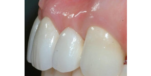 TECNICHE CHIRURGICHE E TECNICHE PROTESICHE PER LA STABILITA’ DEL MARGINE GENGIVALE E DELLE PAPILLE SU DENTI NATURALI