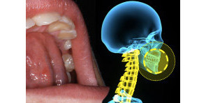 LA DEGLUTIZIONE ATIPICA E LA RESPIRAZIONE ORALE + POSTURAL ORTHODONTIC THERAPY