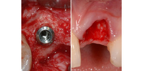 RIGENERAZIONE OSSEA CON TECNICHE SEMPLIFICATE + TECNICHE E STRATEGIE CHIRURGICHE PER GLI IMPIANTI NELLE ZONE ESTETICHE: