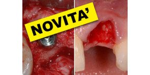 RIGENERAZIONE OSSEA CON TECNICHE SEMPLIFICATE + TECNICHE E STRATEGIE CHIRURGICHE PER GLI IMPIANTI NELLE ZONE ESTETICHE: