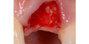 TECNICHE E STRATEGIE CHIRURGICHE PER GLI IMPIANTI NELLE ZONE ESTETICHE: come raggiungere il successo e come recuperare l'insuccesso