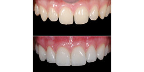 FACCETTE IN CERAMICA NEI SETTORI ANTERIORI - indicazioni, preparazioni, incollaggio