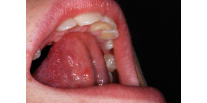 LA DEGLUTIZIONE ATIPICA E LA RESPIRAZIONE ORALE