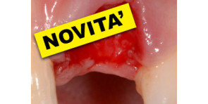 TECNICHE E STRATEGIE CHIRURGICHE PER GLI IMPIANTI NELLE ZONE ESTETICHE: come raggiungere il successo e come recuperare l'insuccesso