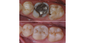 INTARSI IN COMPOSITO NEI SETTORI POSTERIORI