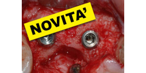 RIGENERAZIONE OSSEA CON TECNICHE SEMPLIFICATE: differenti approcci per differenti situazioni cliniche in implantologia