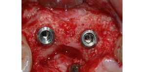 RIGENERAZIONE OSSEA CON TECNICHE SEMPLIFICATE: differenti approcci per differenti situazioni cliniche in implantologia