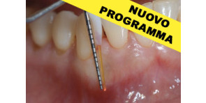 TERAPIA PARODONTALE LASER ASSISTITA e altre indicazioni dei laser a diodo e a erbio in ambito odontoiatrico