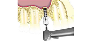 TECNICA DI RIALZO DEL SENO CRESTALE MINIMAMENTE INVASIVA (PRO SCV Sinus Lift)