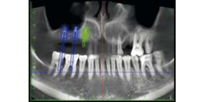LA TECNICA M.I.S.E. (minimal Invasive sinus elevation) nel contesto della chirurgia orale non invasiva:  nuovi approcci al trattamento implantare.