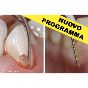 MALATTIE PARADONTALI E PERI-IMPLANTITI + TERAPIA PARODONTALE LASER ASSISTITA