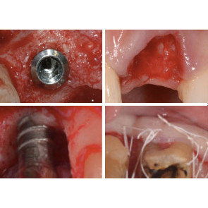 FULL IMMERSION SULLA GESTIONE DEI TESSUTI DURI E MOLLI IN IMPLANTOLOGIA