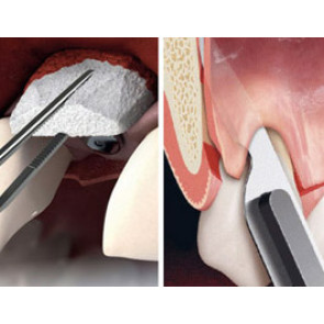 INNESTI DI TESSUTO CONNETTIVO E MATRICI SOSTITUTIVE + L'ALLUNGAMENTO DELLA CORONA CLINICA 