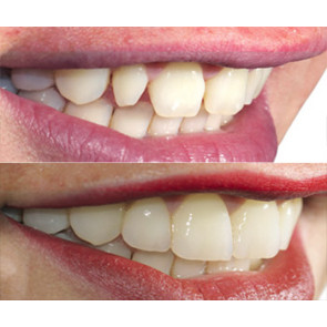 PROTESI ADESIVA, FACCETTE NO-PREP, FACCETTE MINI-INVASIVE