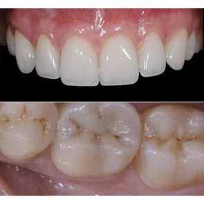 INTARSI IN COMPOSITO NEI SETTORI POSTERIORI + FACCETTE IN CERAMICA NEI SETTORI ANTERIORI