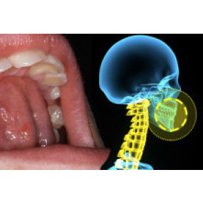 LA DEGLUTIZIONE ATIPICA E LA RESPIRAZIONE ORALE + POSTURAL ORTHODONTIC THERAPY