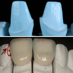 LA PROTESI FISSA SU DENTE NATURALE + FULL IMMERSION SULLA REALIZZAZIONE DI FACCETTE