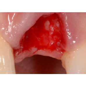 TECNICHE E STRATEGIE CHIRURGICHE PER GLI IMPIANTI NELLE ZONE ESTETICHE: come raggiungere il successo e come recuperare l'insuccesso