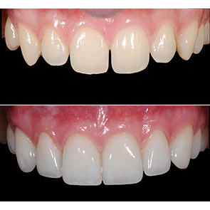 FACCETTE IN CERAMICA NEI SETTORI ANTERIORI - indicazioni, preparazioni, incollaggio