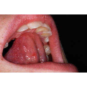 LA DEGLUTIZIONE ATIPICA E LA RESPIRAZIONE ORALE