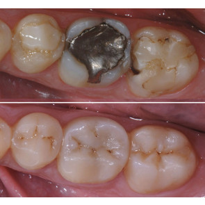 INTARSI IN COMPOSITO NEI SETTORI POSTERIORI