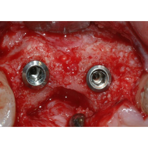RIGENERAZIONE OSSEA CON TECNICHE SEMPLIFICATE: differenti approcci per differenti situazioni cliniche in implantologia