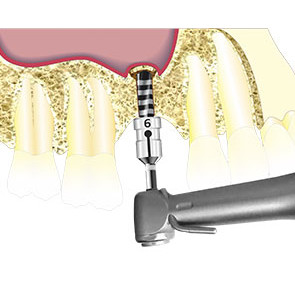 TECNICA DI RIALZO DEL SENO CRESTALE MINIMAMENTE INVASIVA (PRO SCV Sinus Lift)