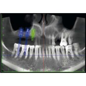 LA TECNICA M.I.S.E. (minimal Invasive sinus elevation) nel contesto della chirurgia orale non invasiva:  nuovi approcci al trattamento implantare.