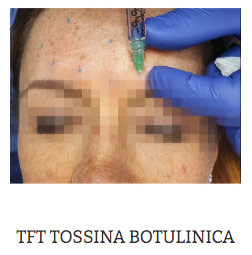 TFT TOSSINA BOTULINICA