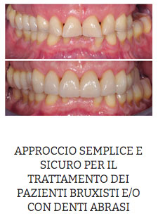 APPROCCIO SEMPLICE E SICURO PER IL TRATTAMENTO DEI PAZIENTI BRUXISTI E/O CON DENTI ABRASI